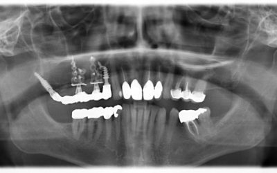 Treatment option in the atrophied maxilla without bonegraft and without sinuslift